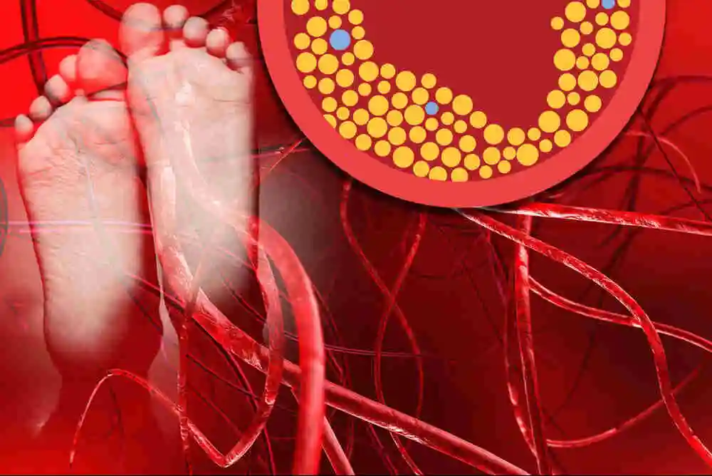 Benefits and Risks of PAD Treatment